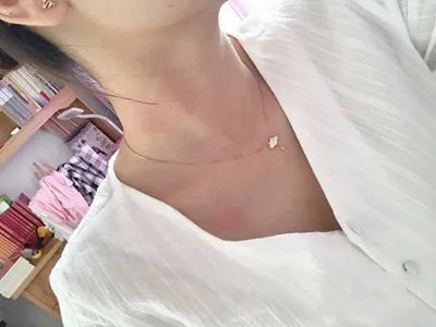 运动诱导性荨麻疹症状图片