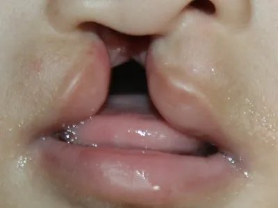 唇裂症状图片