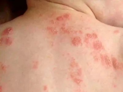 奶癣小红疙瘩图片