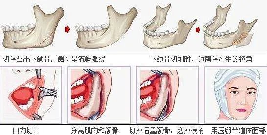 下颌角肥大多少钱