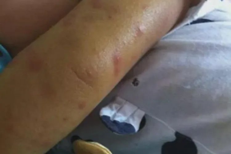 登革热疙瘩图片