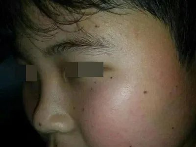 交界痣黑痣图片