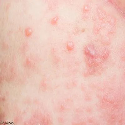 药疹会有哪些症状 药疹可以涂抹派瑞松软膏吗