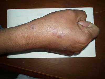 扁平苔藓斑图片