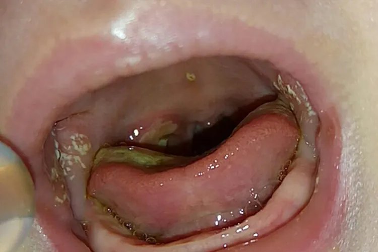 三个月婴儿鹅口疮图片