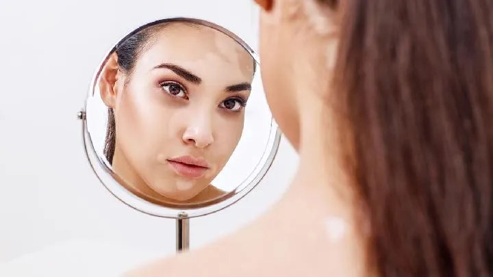 白化病表现什么症状