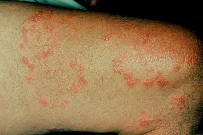 大腿内侧红斑不痛不痒图片