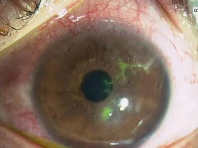 真菌性角膜炎症状图片