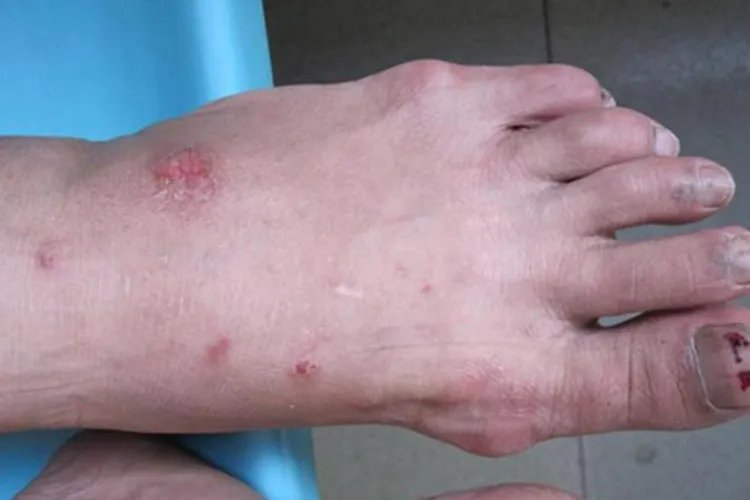 小皮疹图片大全