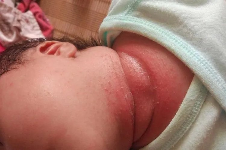 新生儿湿疹初期症状图片大全