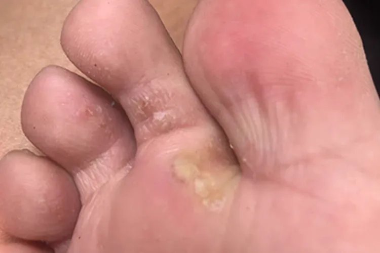 水疱型足癣脚趾缝大水疱图片