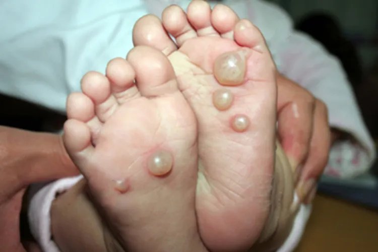 小儿手足口病最早期图片
