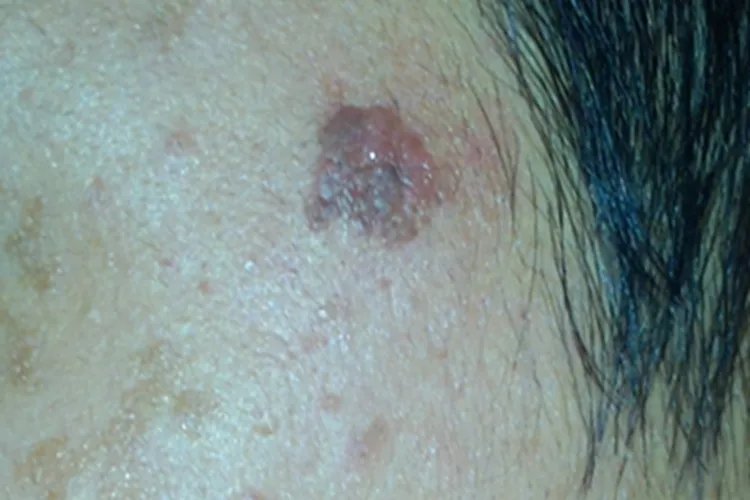 黑素瘤症状图片