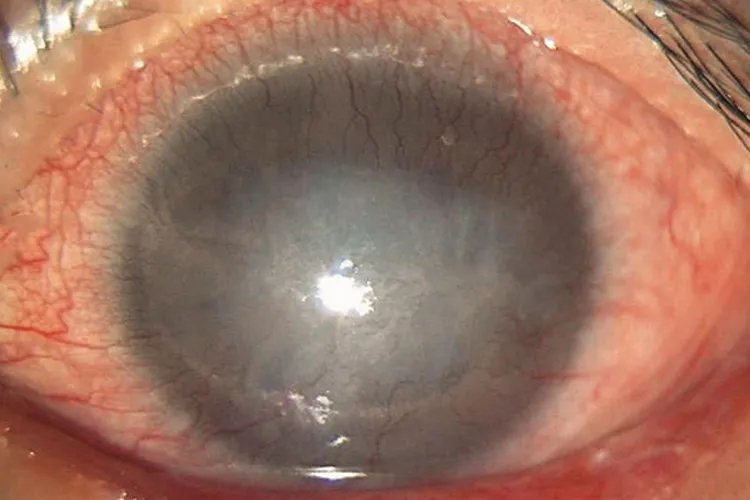 沙眼图片和正常眼睛图片对比