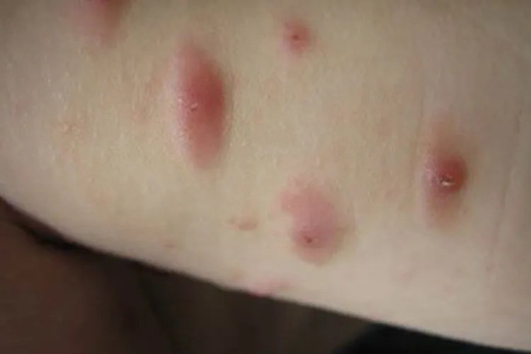 结节性痒疹图片