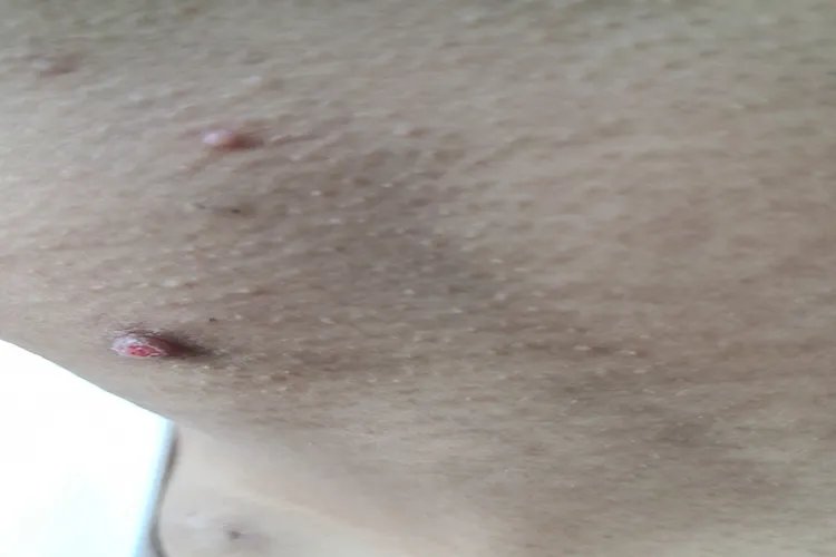 什么是刺瘊子图片大全