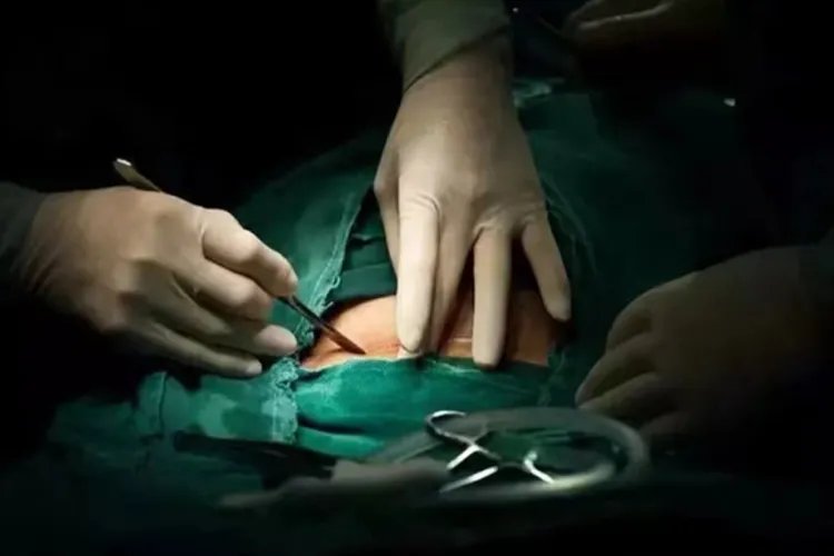 剖腹产7层全过程图片