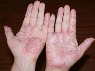 手部湿疹红斑图片