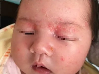 奶癣小红疙瘩图片