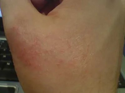 手部湿疹红斑图片