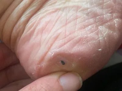 交界痣黑痣图片