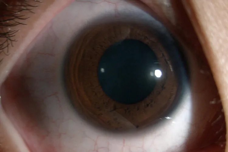 上眼皮红肿痒图片