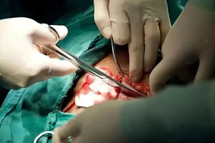 剖腹产7层全过程图片