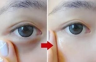 修复眼袋多少钱