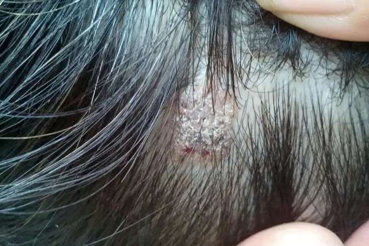 头皮屑症状图片