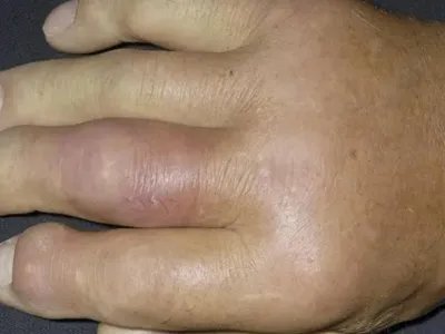 蜂窝织炎红肿图片