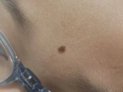 交界痣黑痣图片