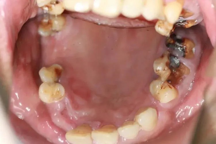 蛀牙的虫子长啥样图片