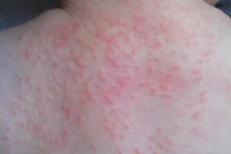 痱子长啥样图片