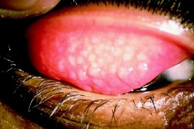 沙眼图片和正常眼睛图片对比