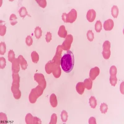 慢性粒细胞白血病的危害有哪些