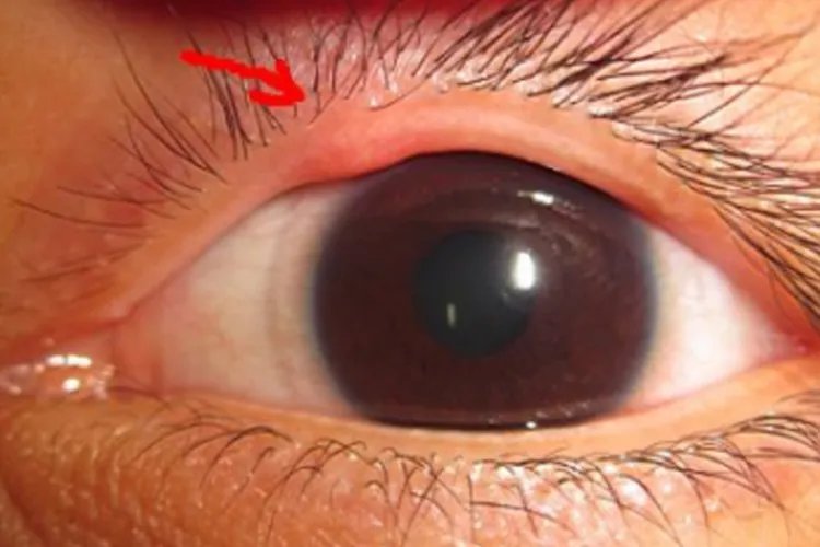 眼睛要长麦粒肿前兆图片