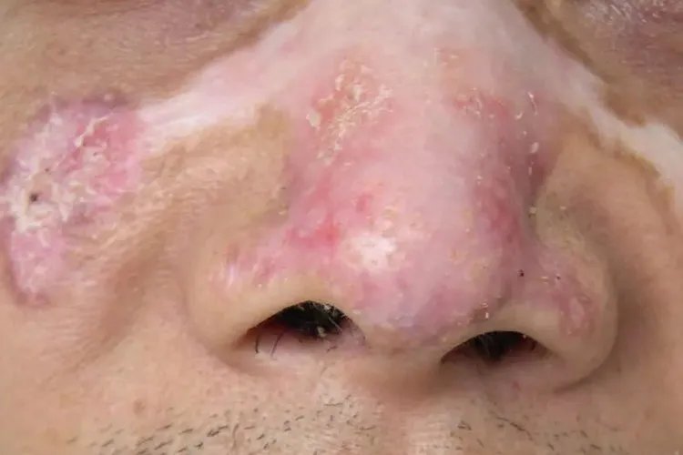 轻度红斑狼疮图片