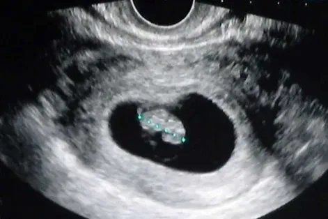 怀孕两个月胎儿真实图片