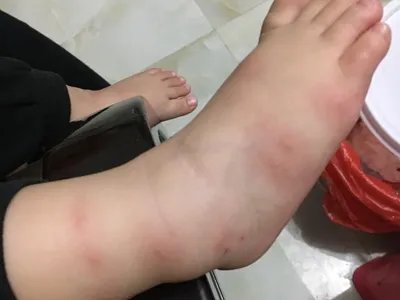 跳蚤叮咬小疙瘩图片