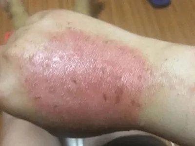 手部湿疹红斑图片