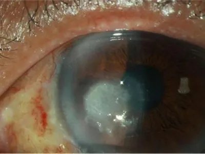 真菌性角膜炎症状图片