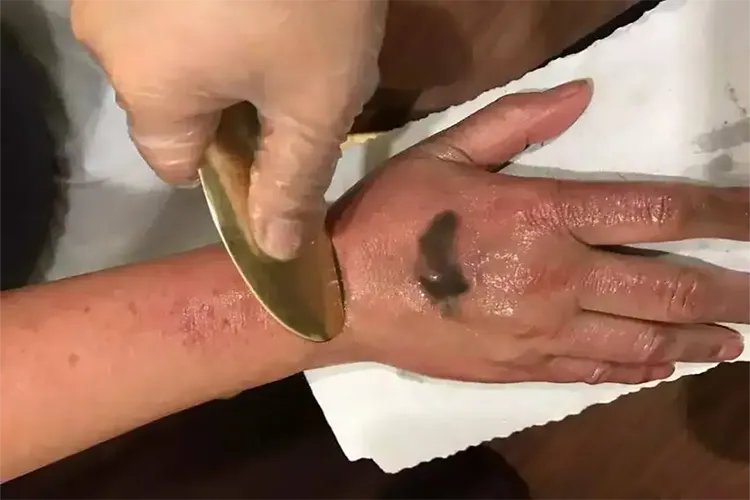 手部刮痧示意图