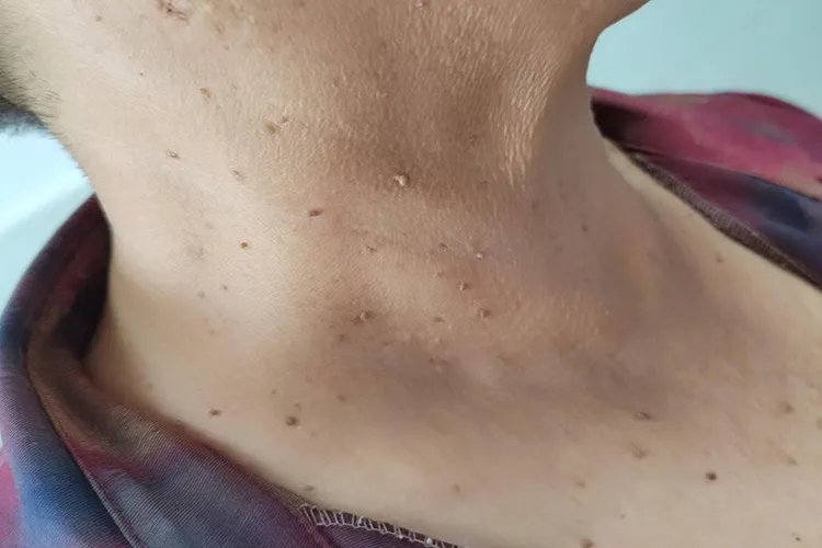 什么是刺瘊子图片大全