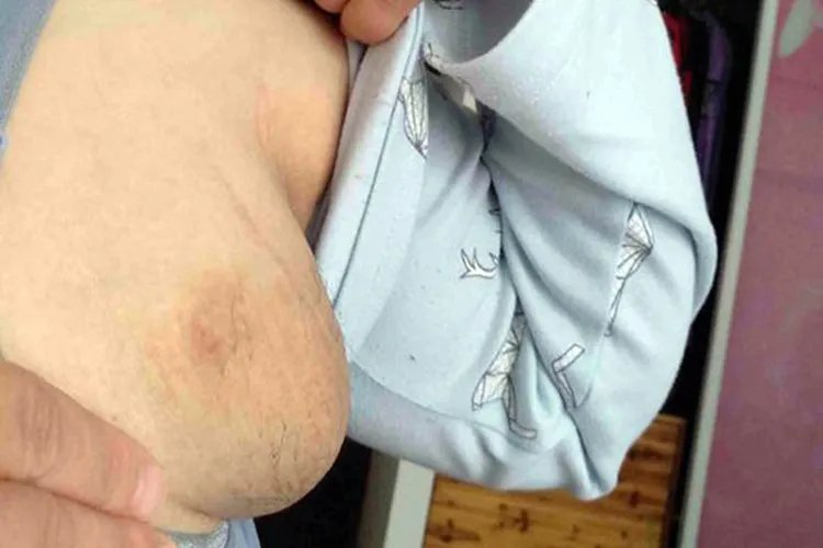 什么是副乳及图片