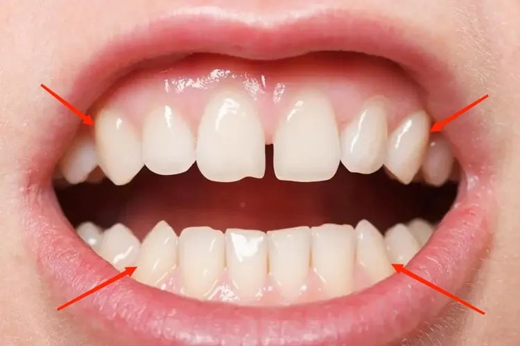 正常虎牙长什么样的图片