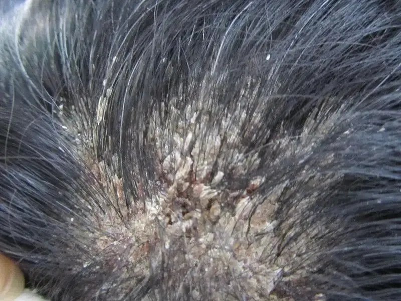 头皮屑症状图片