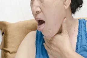 臭虫图片咬人后图片