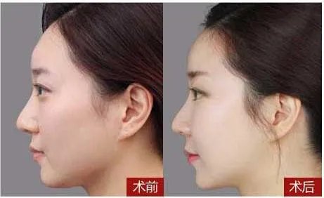 脂肪填充全脸好吗