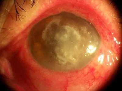 真菌性角膜炎症状图片