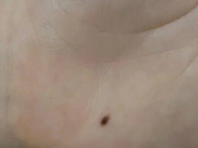 交界痣黑痣图片